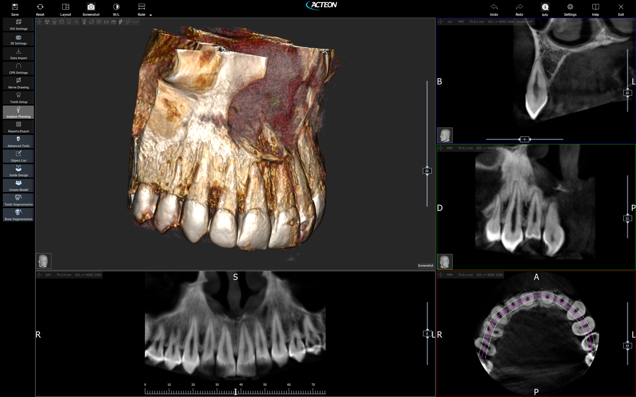 Acteon Optima 3D CBCT 17x12 FOV