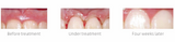 Woodpecker LX16 PLUS Smart Laser Dental Diode Laser
