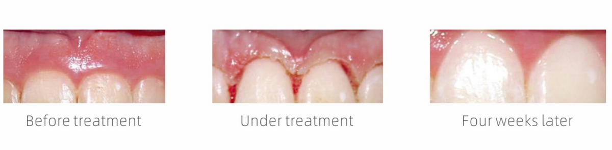 Woodpecker LX16 PLUS Smart Laser Dental Diode Laser