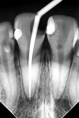 Woodpecker Intraoral Sensor Size 1